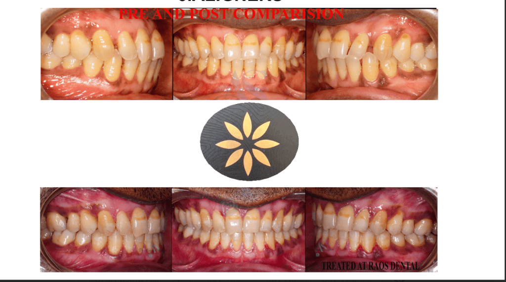 Dr Rao's dental clinic has affordable aligners