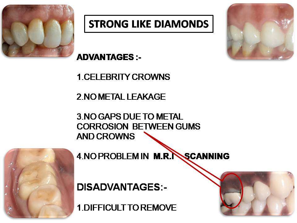 Dr Rao's dental centre provides world class yet affordable biometric crowns