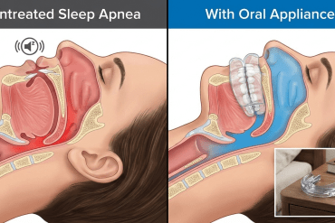 Sleep apnea