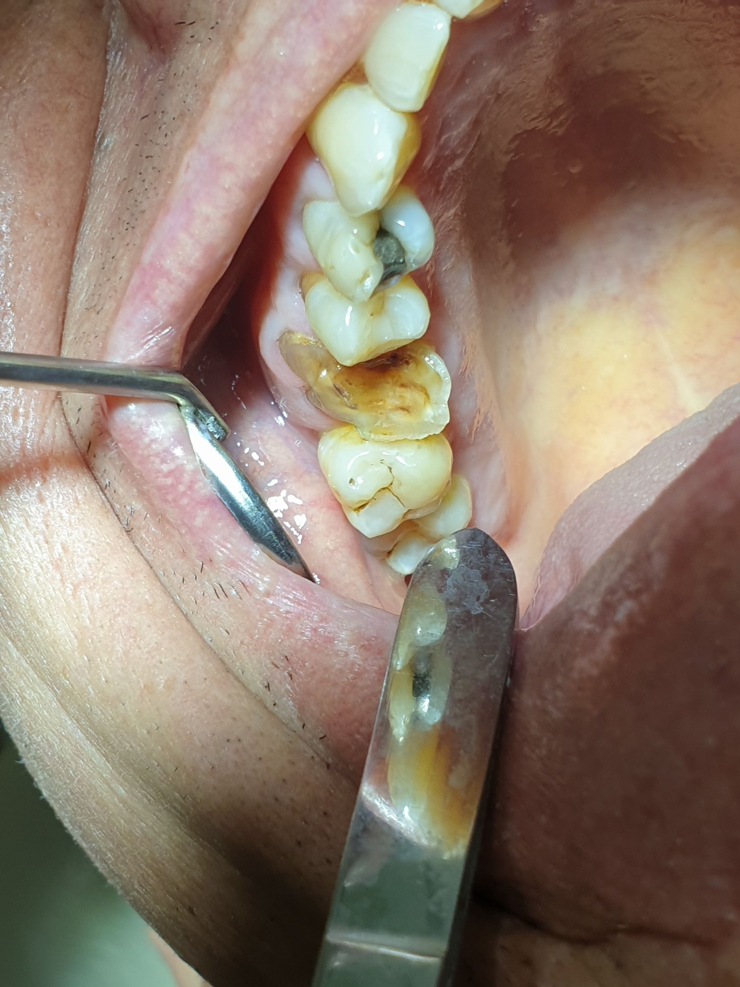 Mr. David Folkes after full mouth rehabilitation at Dr Rao's Dental Centre