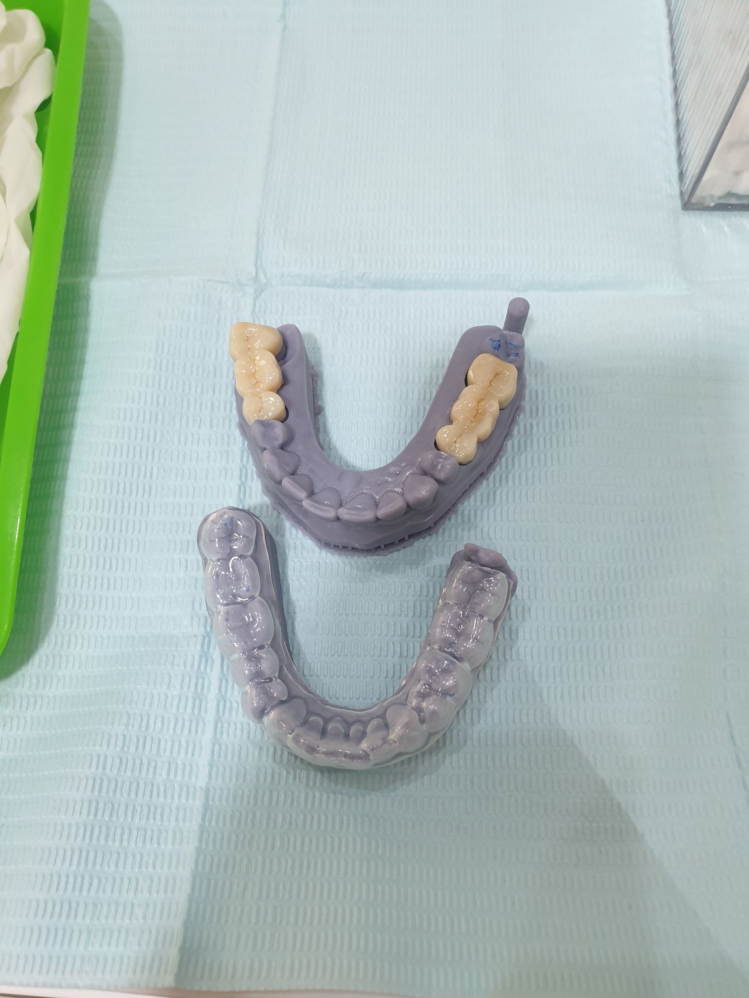 Custom zirconia dental crowns and bridges mounted on 3D-printed jaw models for precise prosthetic planning.