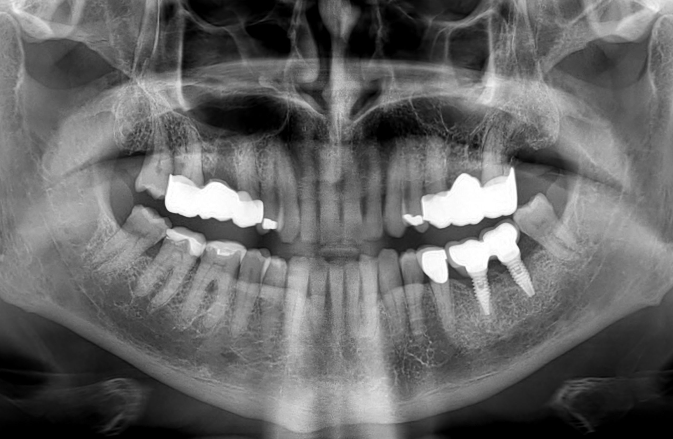 Post-treatment full mouth panoramic X-ray showing custom dental bridges and implants at Doctor Dental Care.