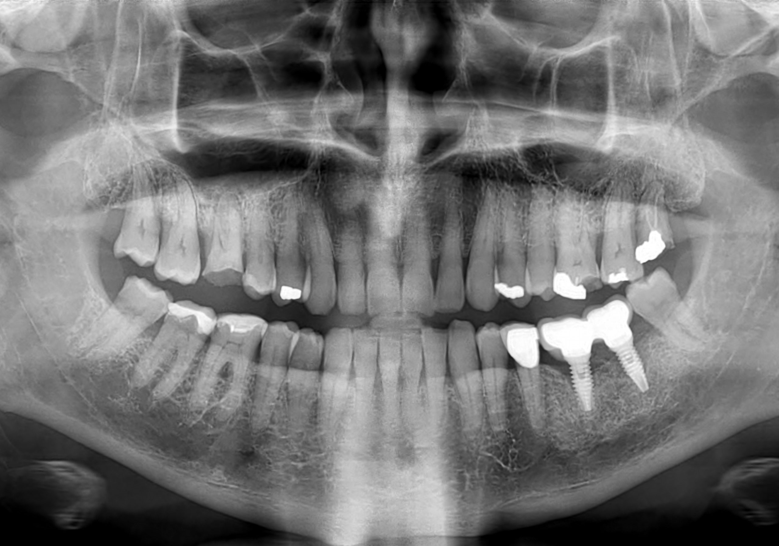 Full mouth panoramic dental X-ray (OPG) showing initial teeth condition and implants at Doctor Dental Care clinic.