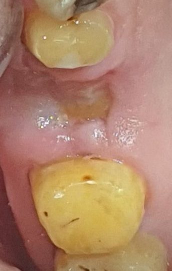Healthy gum tissue and soft tissue healing 4 days after laser-assisted tooth extraction treatment.