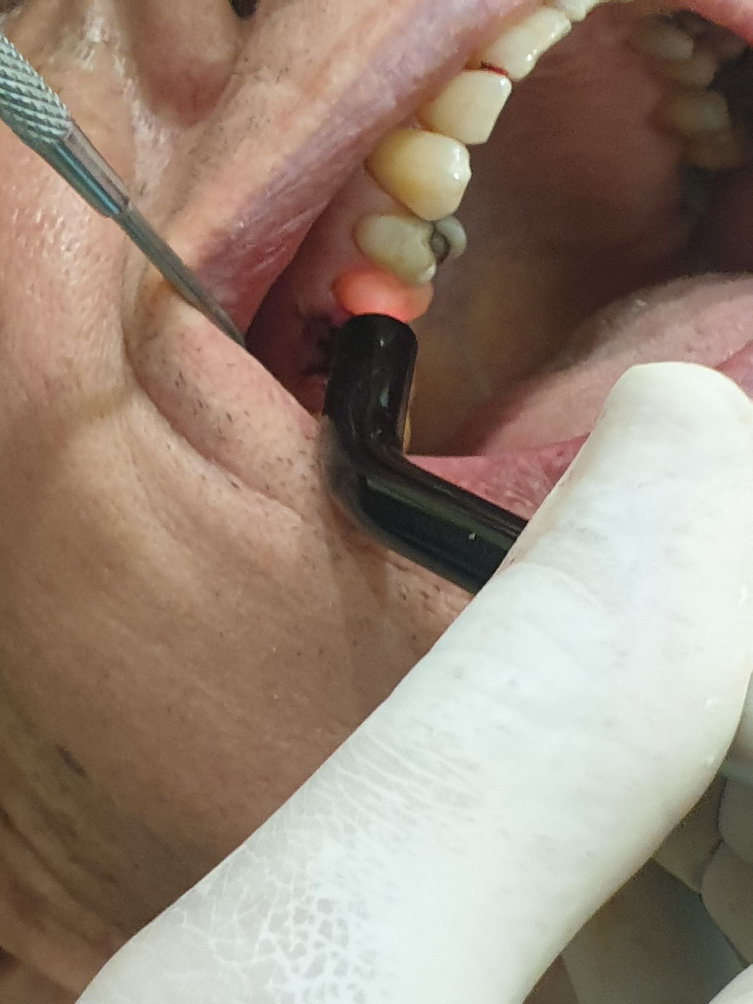 Application of low-level laser therapy directly to the surgical site to accelerate healing after tooth extraction.