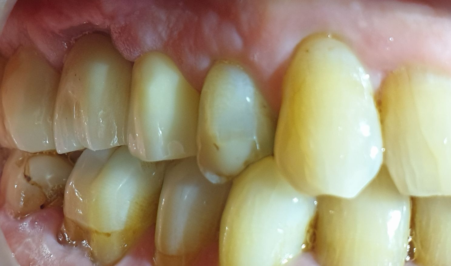 Close-up view of permanently fixed zirconia dental crowns showing natural aesthetic integration with adjacent teeth.