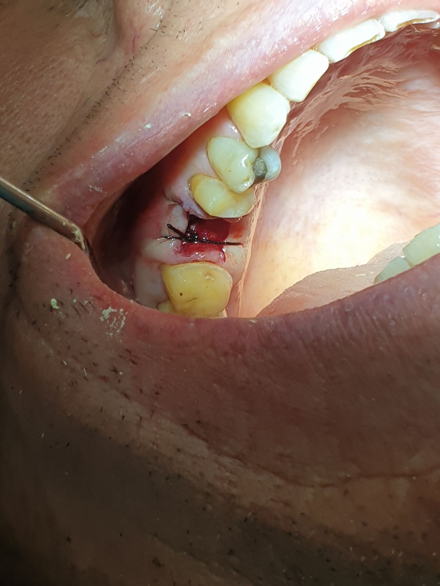 Surgical site following tooth extraction secured with dental sutures at Doctor Dental Care.
